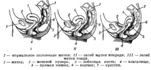 Смещение матки при беременности