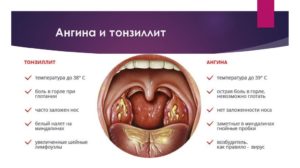 38 неделя беременности болит горло чем лечить