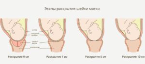 Чувствуется ли раскрытие шейки матки при беременности