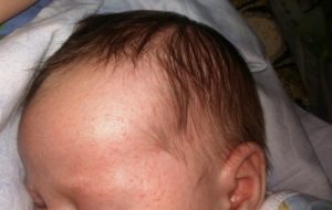 Почему у новорожденных выпадают волосы