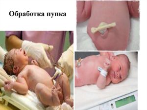 Обработка пупка после роддома