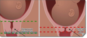 Роды с короткой шейкой матки