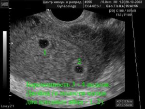 Многоплодная беременность на узи на ранних сроках