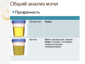 У ребенка мутная моча и температура