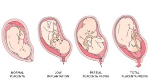 Опустилась плацента при беременности