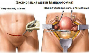 Сухость после удаления матки