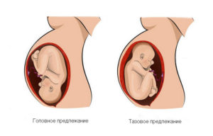 Головное предлежание плода при беременности на 20 недели