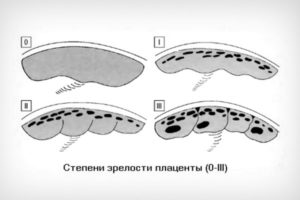 Плацента когда начинает стареть