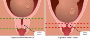 Роды с короткой шейкой матки