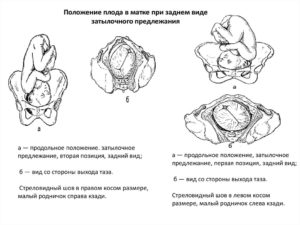 Позиции плода в матке