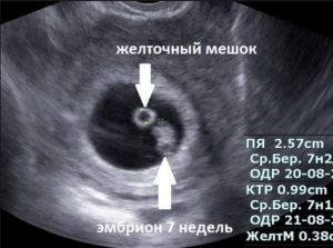 Желточный мешок 1 мм