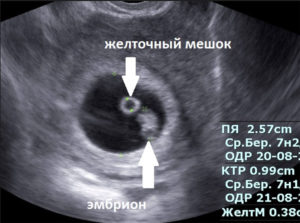 На какой неделе беременности видно плодное яйцо