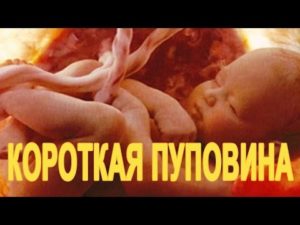 Короткая пуповина при родах