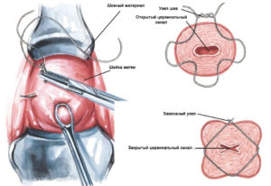 Шов на шейку матки при беременности как накладывают