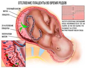 При беременности отошла плацента