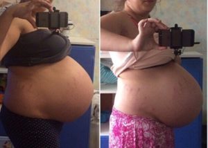Признаки опущения живота перед родами