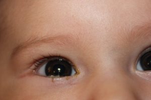 Почему слезятся глаза у ребенка
