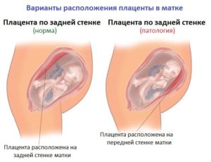 Плацента расположена по задней стенке матки в дне