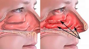 При беременности забит нос