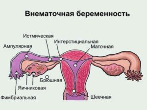 Внематочная беременность с какой стороны