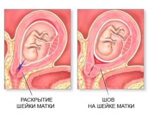 Тонус матки при беременности из за запора