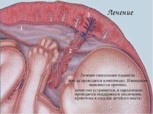 Кальциноз 1 степени плаценты