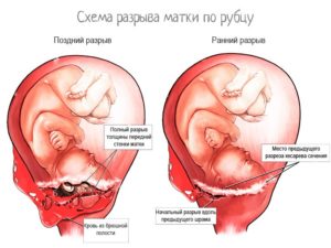 Рубец на матке и беременность