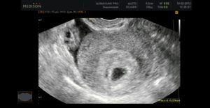 4 недели от зачатия что видно на узи