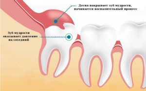 Режется зуб мудрости при беременности