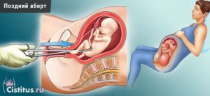 Когда после выскабливания можно забеременеть