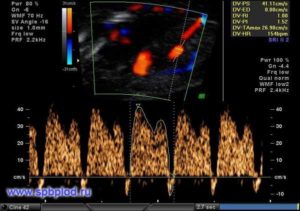 Кровоток в венозном протоке у плода норма