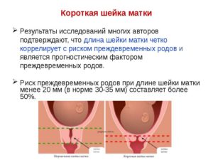 Роды с короткой шейкой матки