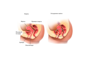 После родов опущение матки