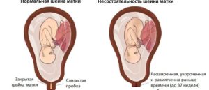 Матка до беременности и во время беременности