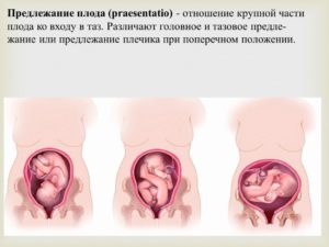 Предлежание плода это отношение