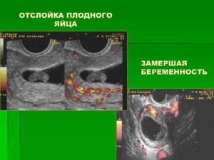 Отслойка плодного яйца на ранних сроках беременности последствия