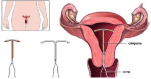 Когда можно ставить спираль после родов при гв