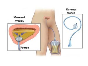 Катетер фолея больно ли ставить