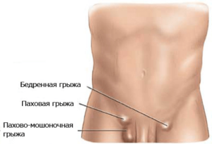 Грыжа у ребенка в паху