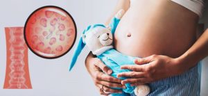 Бактериальный вагиноз у беременных