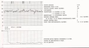 Ктг 38 недель расшифровка