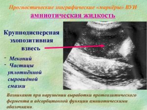 Эховзвесь в околоплодных водах причины