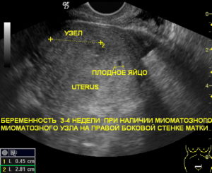 Можно ли на узи перепутать миому с беременностью