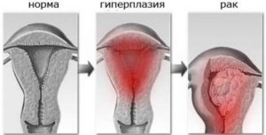 Гиперплазия эндометрия что это такое при климаксе лечение