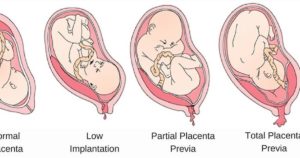 20 недель низкая плацентация