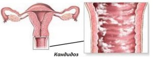 Молочница при зачатии ребенка