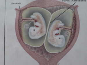Амниотическая перегородка при двойне