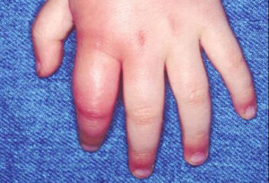 Ребенка за палец укусила оса