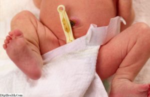 Что делать если у новорожденного отвалился пупок