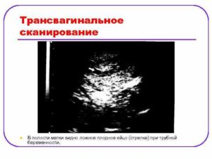 На каком сроке плодное яйцо опускается в матку